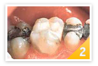 Zahn mit weisser Kunststofffuellung (Basisversorgung)